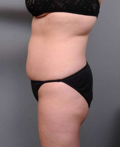 Liposuction Before & After Patient #681
