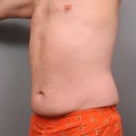 Liposuction Before & After Patient #688