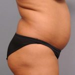 Liposuction Before & After Patient #695
