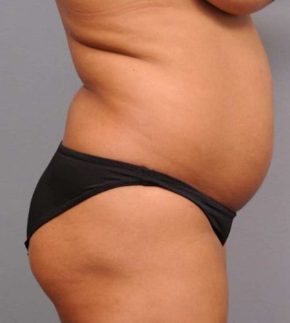 Liposuction Before & After Patient #695