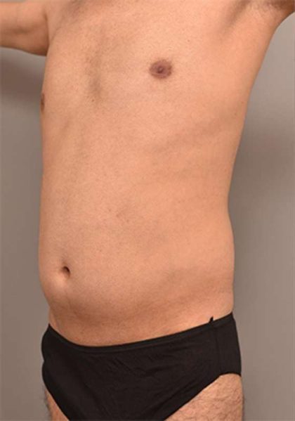 Liposuction Before & After Patient #704