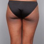 Liposuction Before & After Patient #709