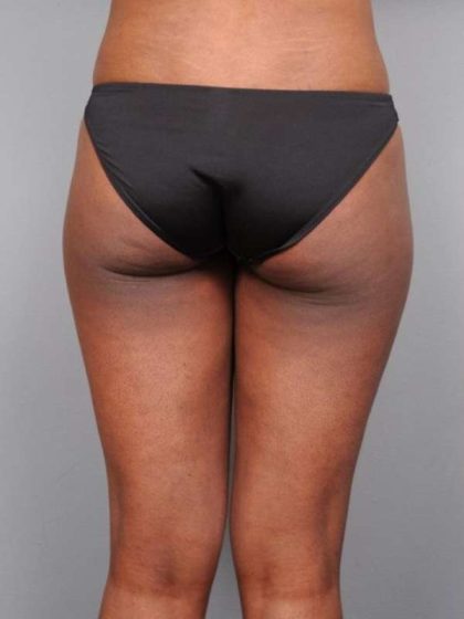 Liposuction Before & After Patient #709