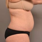 Tummy Tuck Before & After Patient #273
