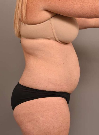 Tummy Tuck Before & After Patient #273