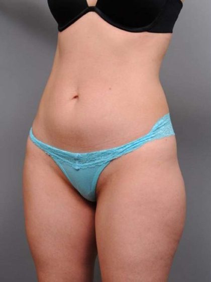 Liposuction Before & After Patient #716