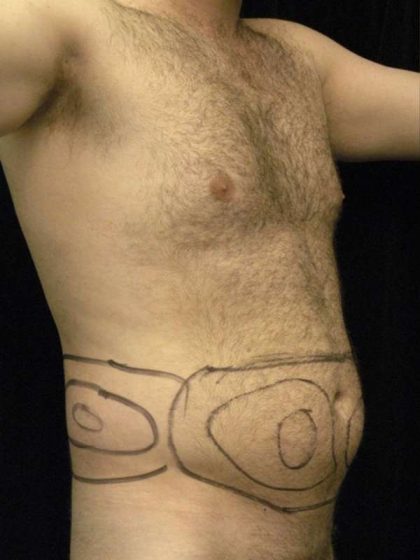 Liposuction Before & After Patient #726