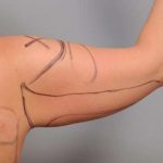 Liposuction Before & After Patient #731