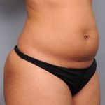 Liposuction Before & After Patient #738