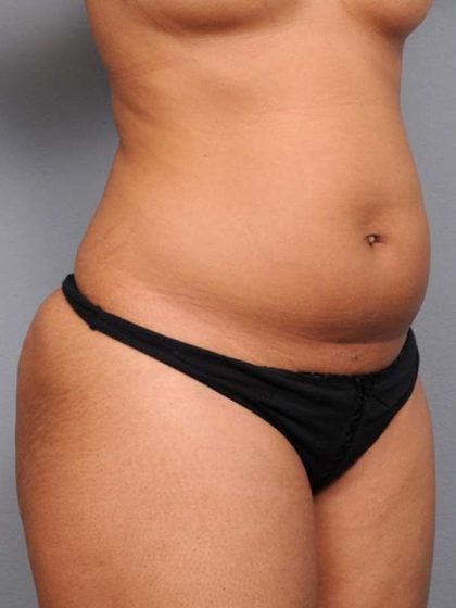Liposuction Before & After Patient #738