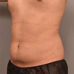 Liposuction Before & After Patient #749