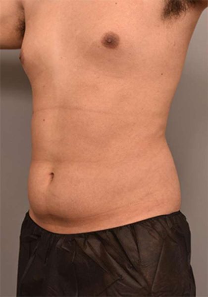 Liposuction Before & After Patient #749