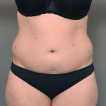 Liposuction Before & After Patient #756