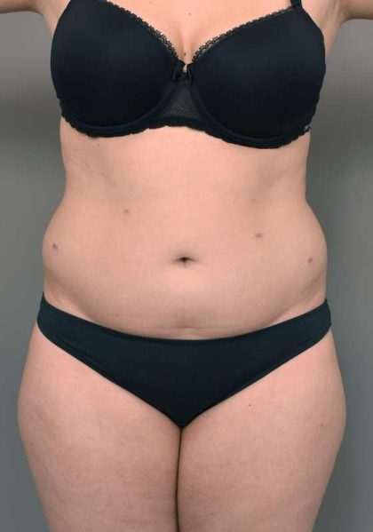 Liposuction Before & After Patient #756