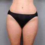 Liposuction Before & After Patient #761