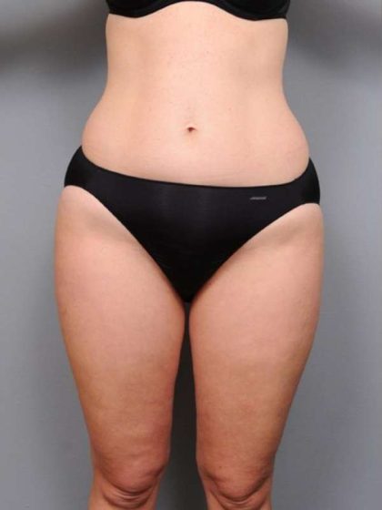 Liposuction Before & After Patient #761