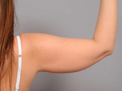 Liposuction Before & After Patient #768