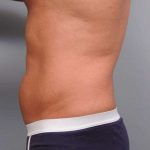 Liposuction Before & After Patient #783