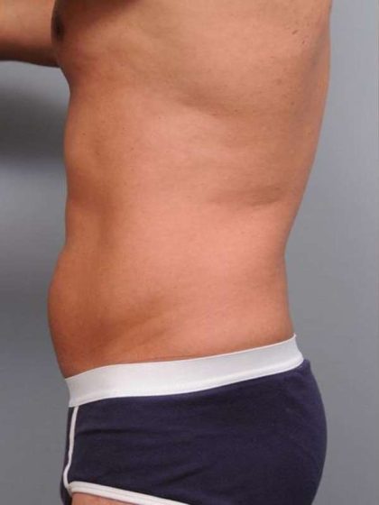 Liposuction Before & After Patient #783