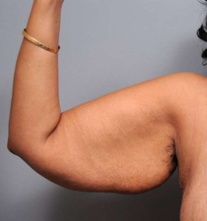 Arm Lift Before & After Patient #790