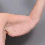 Arm Lift Before & After Patient #795