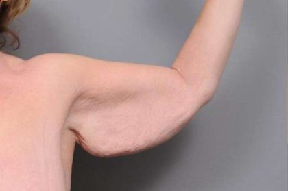 Arm Lift Before & After Patient #795