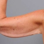 Arm Lift Before & After Patient #800