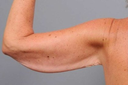 Arm Lift Before & After Patient #800