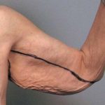 Arm Lift Before & After Patient #807