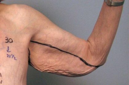 Arm Lift Before & After Patient #807