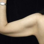Arm Lift Before & After Patient #814