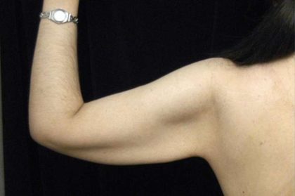 Arm Lift Before & After Patient #814
