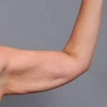 Arm Lift Before & After Patient #819