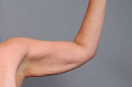 Arm Lift Before & After Patient #819