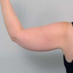 Arm Liposuction Before & After Patient #826