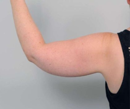 Arm Liposuction Before & After Patient #826
