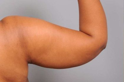 Arm Liposuction Before & After Patient #833