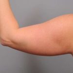 Arm Liposuction Before & After Patient #842