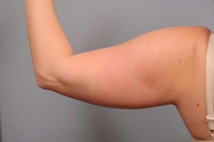 Arm Liposuction Before & After Patient #842