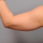 Arm Liposuction Before & After Patient #851