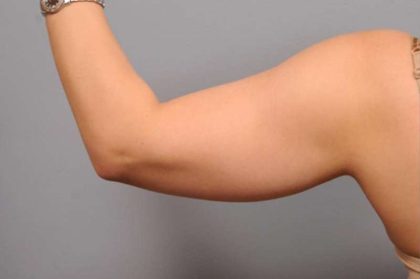 Arm Liposuction Before & After Patient #851