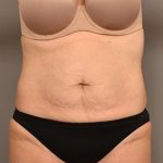 Tummy Tuck Before & After Patient #287