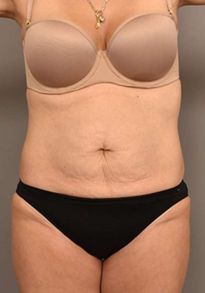 Tummy Tuck Before & After Patient #287