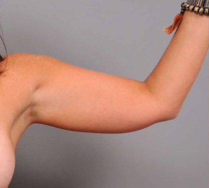 Arm Liposuction Before & After Patient #858