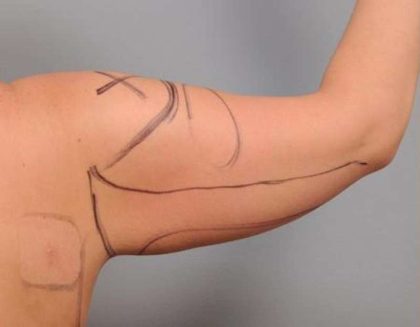 Arm Liposuction Before & After Patient #863