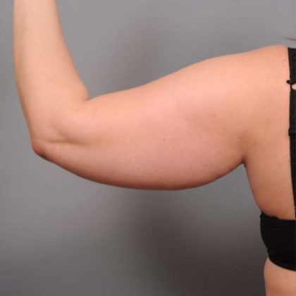 Arm Liposuction Before & After Patient #872