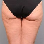 Thigh Lift Before & After Patient #896