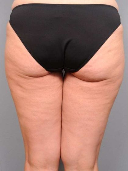 Thigh Lift Before & After Patient #896