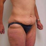 Lower Body Lift Before & After Patient #925