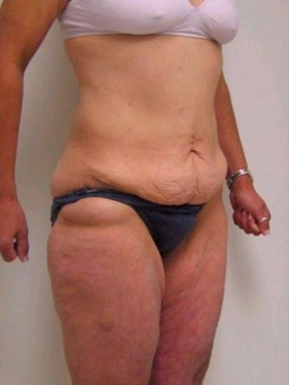 Lower Body Lift Before & After Patient #925